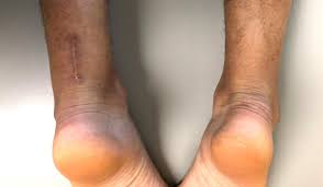 Achilles Heel Surgery